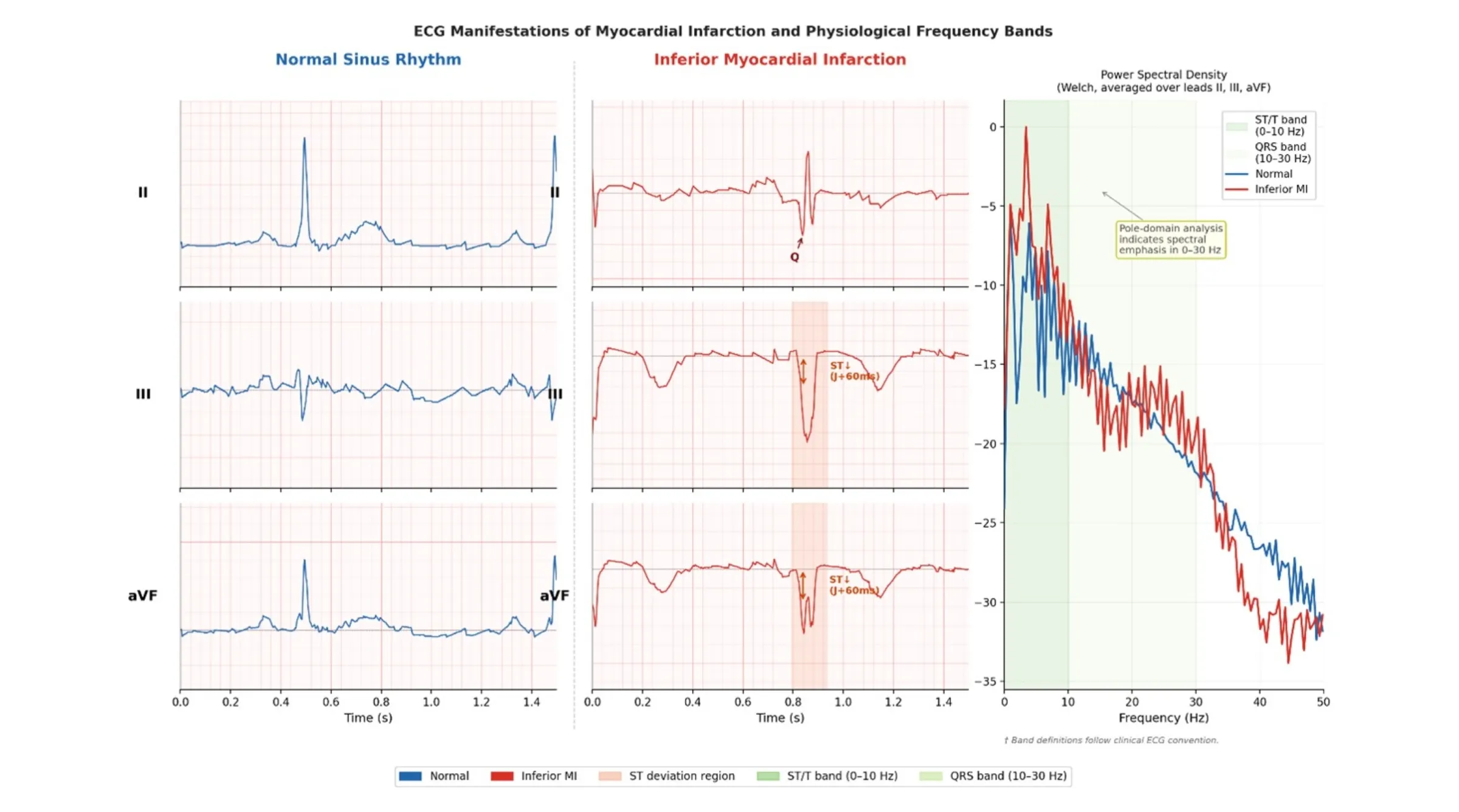 Biểu đồ so sánh tín hiệu điện tâm đồ bình thường và nhồi máu cơ tim, minh họa cách AI phân tích dải tần để nhận diện bất thường